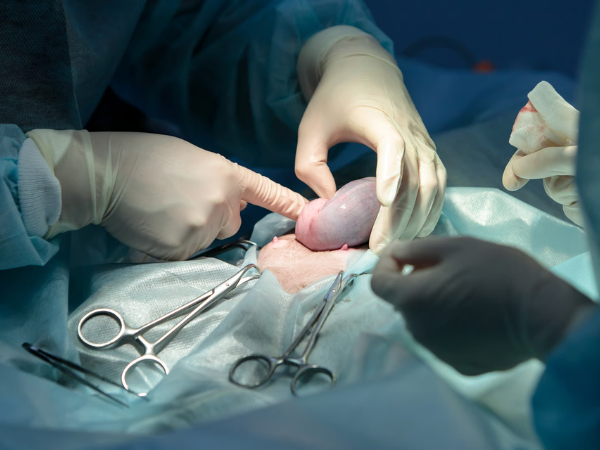 Laparoscopic Sleeve Gastrectomy